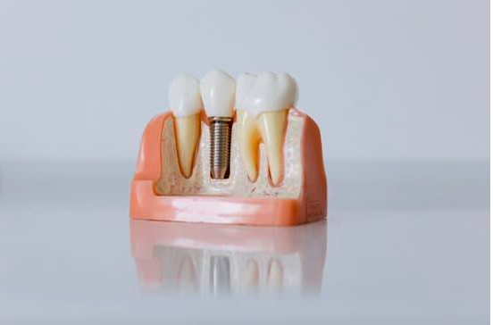 Dental Implant Clinic In Noida India