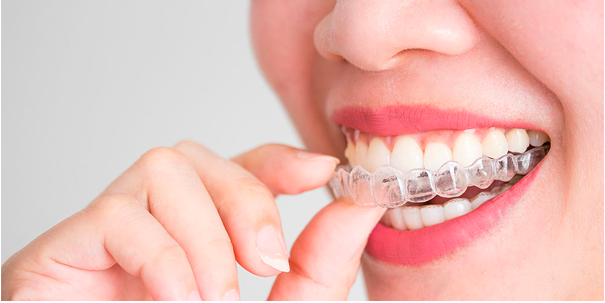 Invisible Teeth Aligners