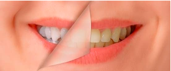 Teeth Whitening